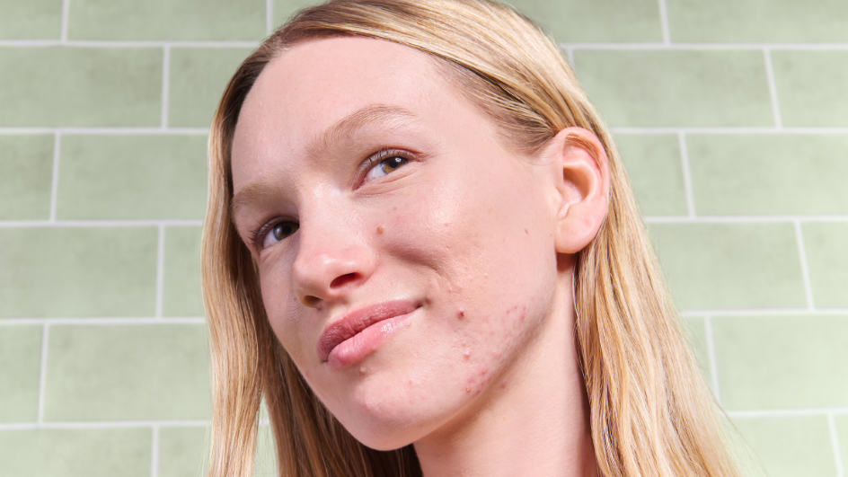 [MS DON'T TOUCH] Everything You Need to Know About Acne